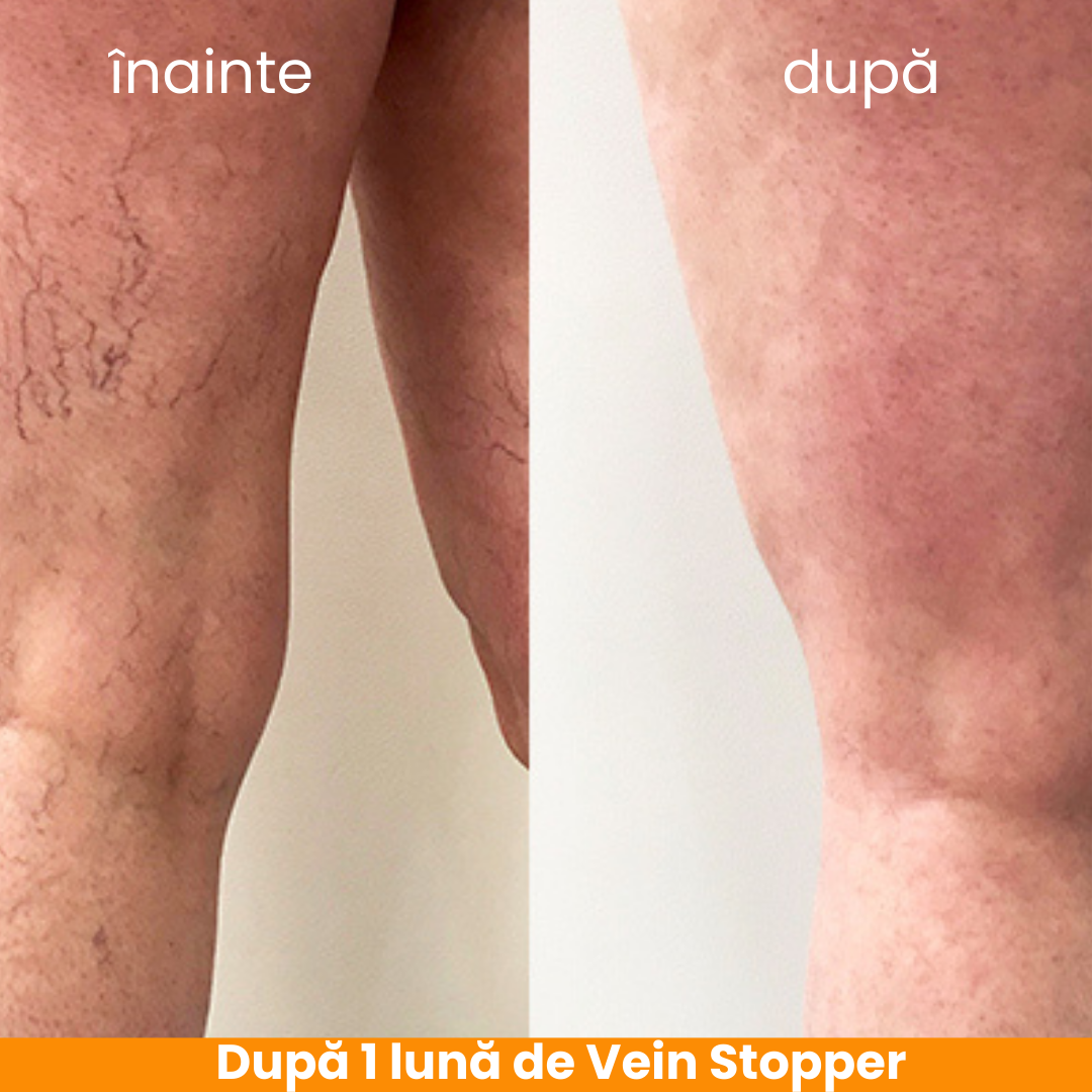 Vein Stopper – cremă antivarice și pentru picioare obosite